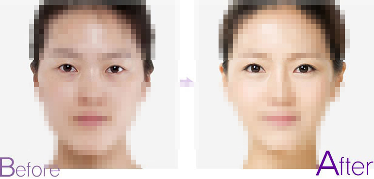 双眼皮前后对比图,埋线双眼皮前后对比照