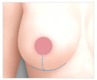 苏亚美联臣乳房下垂矫正术