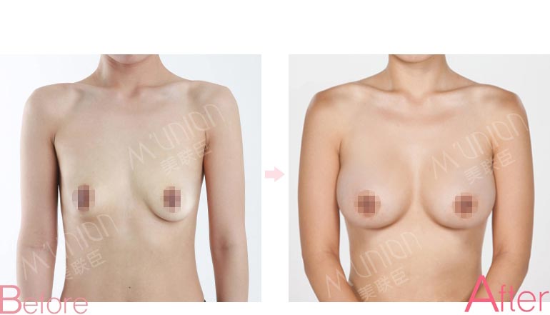 乳房下垂矫正术前后对比图