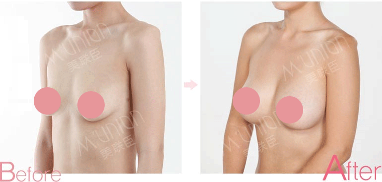 乳房提升前后对比照片