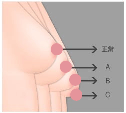 石家庄胸部下垂提升