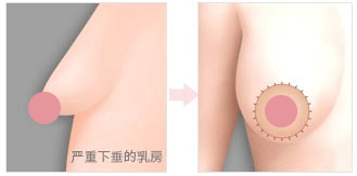 美联臣乳房下垂矫正术
