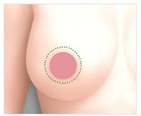 美联臣乳房下垂矫正术