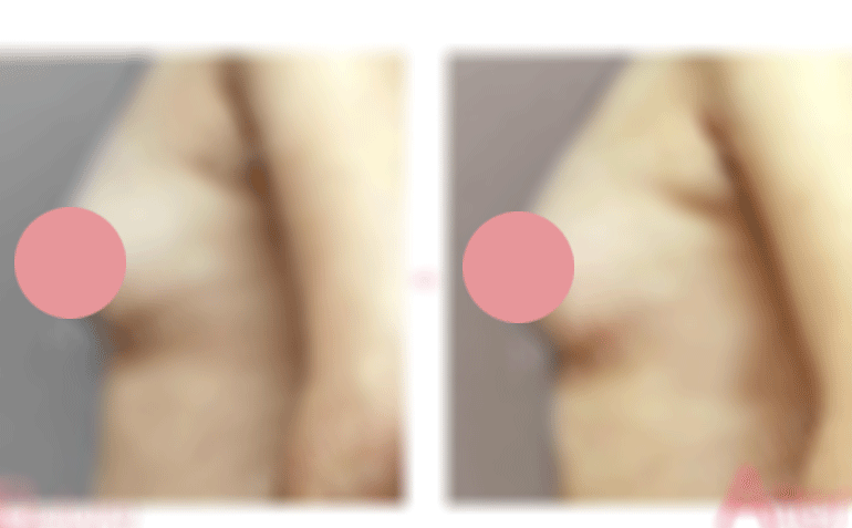 乳头矫正前后对比照片