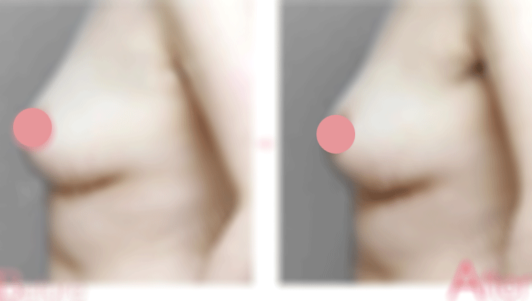 乳头下陷术前后对比照