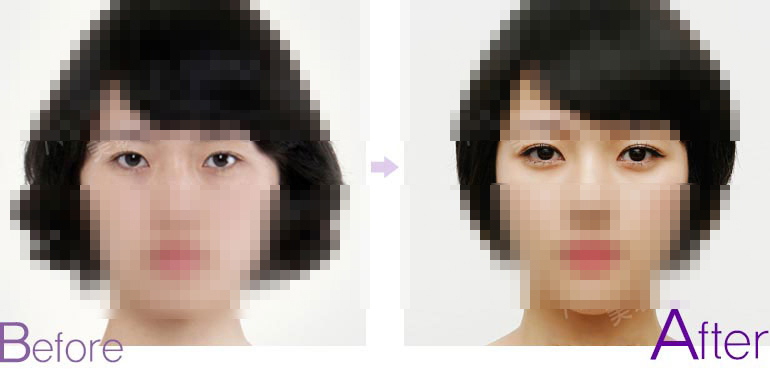 定位双眼皮对比图