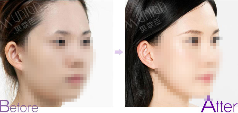 石家庄苏亚美联臣纹眉