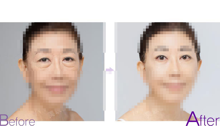 眼睑下垂手术前后对比照