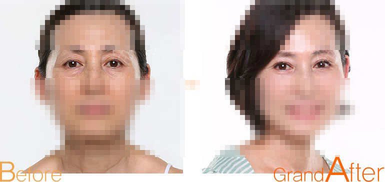 上睑松弛矫正效果图