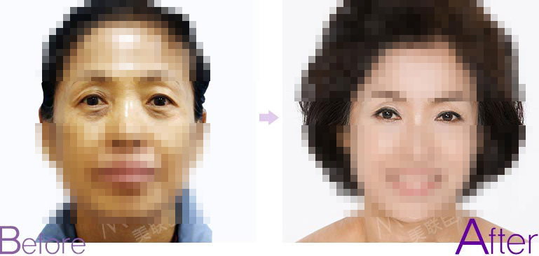 眼睑下垂矫正对比图片