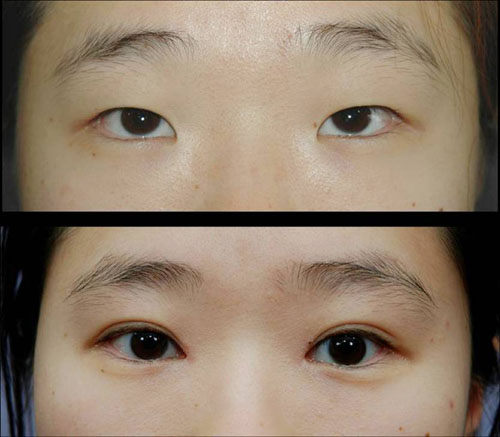 双眼皮手术对比图-眼部整形案例-石家庄美联臣