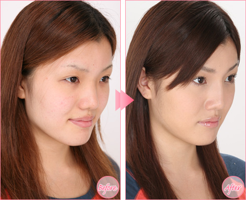 <em>隆鼻</em>前后<em>照片</em>-注射美容-石家庄美联臣整形医院