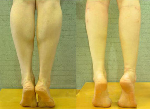 瘦小腿前后对比照片-小腿整形案例-石家庄美联