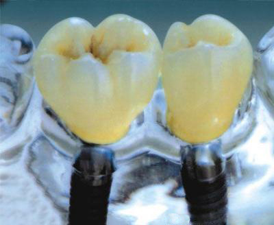 种牙疼吗?微创技术种植牙让牙齿完美无缺-牙齿