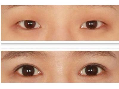 石家庄开眼角哪家医院好?-眼角开大术-石家庄