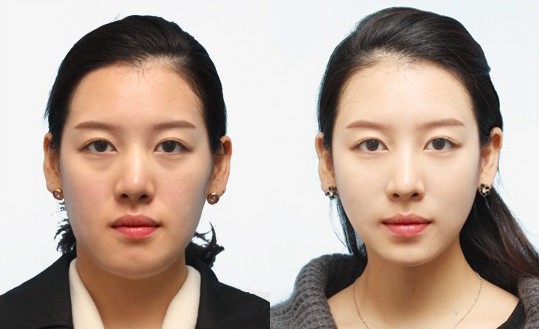 怎么瘦脸的两侧 4955778195.jpg