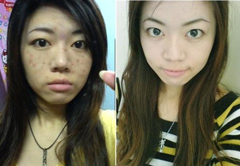 石家庄脸上<em>长痤疮怎么办</em>?吃药有用吗?-激光祛