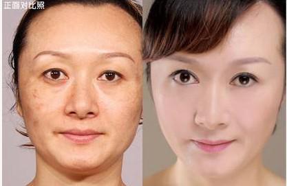 石家庄激光祛除雀斑前准备?-绿宝石镭射祛斑-