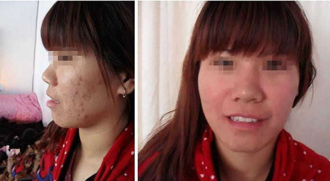 石家庄激光祛痘疤多少钱?2014祛痘价格表-激