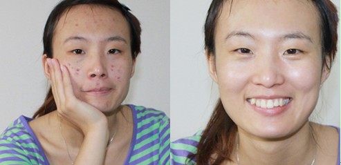 石家庄激光祛痘印安全吗?对比图-激光去痘印-