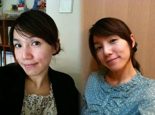 石家庄激光祛痘印的效果怎么样?