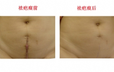 石家庄如何祛除手术疤痕?