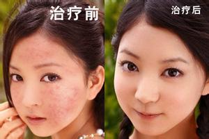 石家庄激光祛痘效果怎么样?真人对比图 -激光