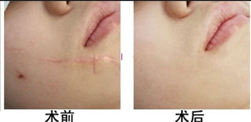 石家庄激光治疗烧伤疤痕安全吗? 网友体验!-激