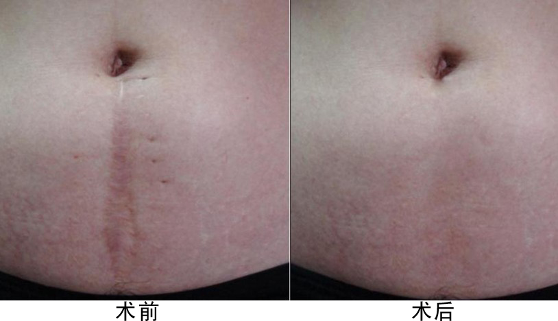 石家庄激光治疗手术疤痕修复特点有哪些?