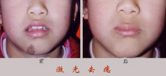 石家庄激光去黑色素痣的效果好吗?对比图-激光