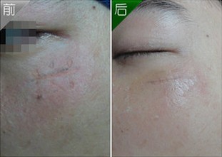 石家庄用什么方法祛除手术疤痕?