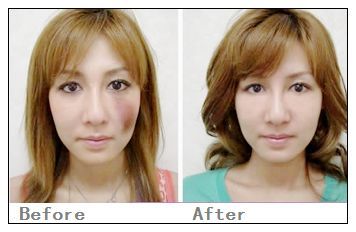 石家庄怎样去除手术疤痕?