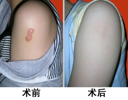 石家庄影响手术疤痕的治疗价格因素?专家解答