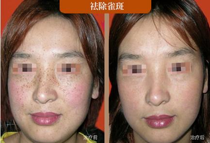 韩国调Q激光祛斑的效果是否会反弹?-王者风范