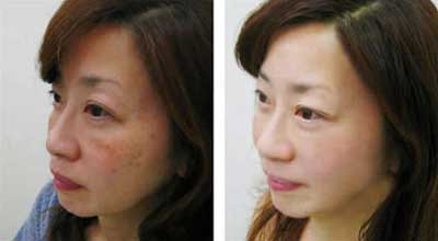 石家庄韩国调Q激光祛斑的价格是多少?