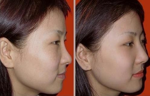 夏日祛斑 韩国调Q祛斑会反弹吗?-绿宝石镭射祛