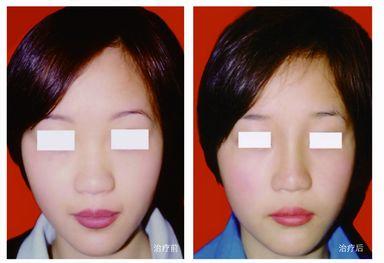 什么方法可以让鼻梁变高 5805982326.jpg