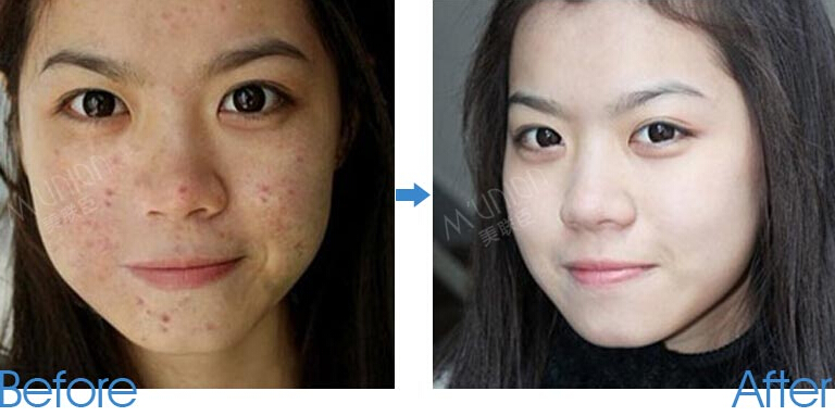 石家庄有什么办法可以祛除脸上的痘疤?-激光祛