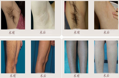 石家庄哪里有好点的一次性脱毛?-激光脱腋毛-