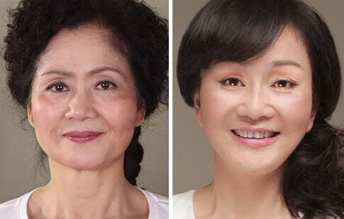 石家庄botox注射除皱医院哪家好?