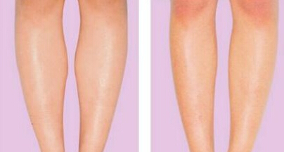 石家庄BOTOX瘦腿针瘦腿效果怎么样?-botox-石