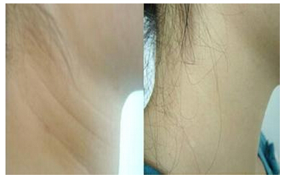 石家庄脖子上的皱纹要怎么去掉才好呢-注射除