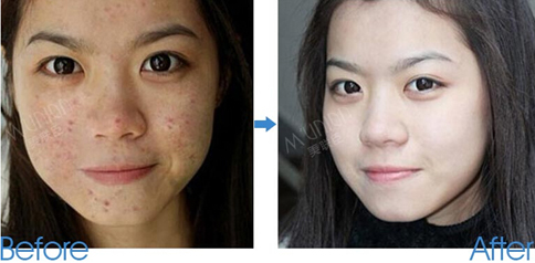 石家庄脸上的痘坑能去掉吗-激光去痘印-石家庄